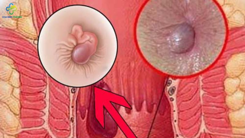 Trĩ ngoại là tình trạng các tĩnh mạch ở vùng hậu môn bị phình to và sưng lên, tạo thành các búi trĩ nằm phía ngoài