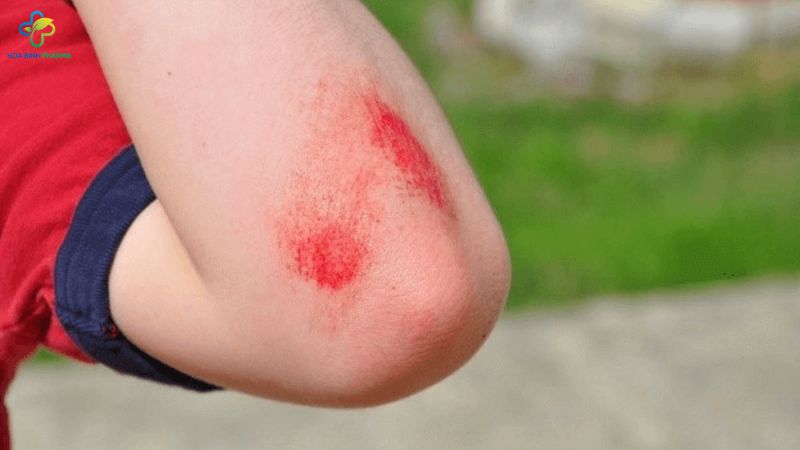 Vết thương hở là tình trạng da bị tổn thương khiến bề mặt ngoài của da, lớp biểu bì không còn nguyên vẹn