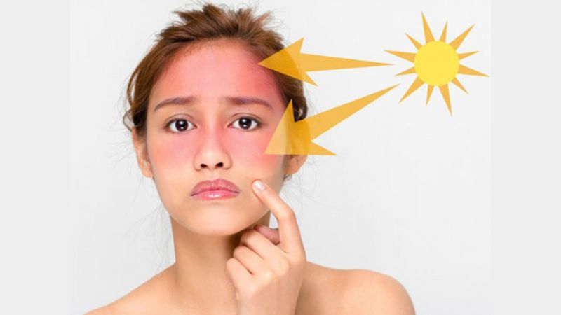Tình trạng cháy nắng, sạm da, da bị kích ứng nhẹ hoặc nổi mẩn đỏ do phơi nắng quá lâu không còn hiếm gặp