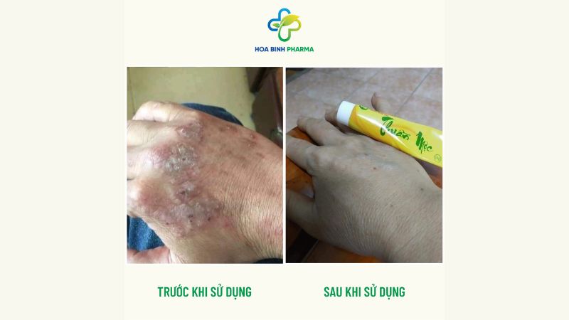 Bằng việc chăm sóc đúng cách và lối sống phù hợp, hoàn toàn có thể kiểm soát được viêm da cơ địa