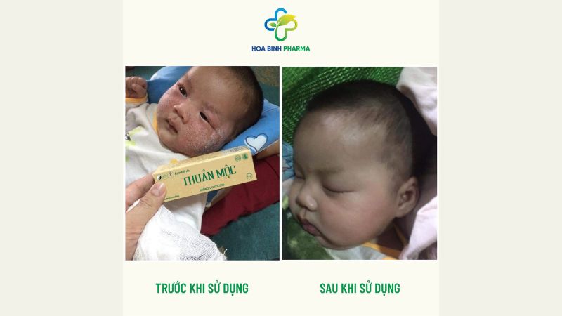 Sử dụng kem bôi da Thuần Mộc kết hợp chăm sóc da và giữ vệ sinh cá nhân cẩn thận