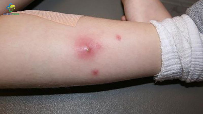 Mụn có thể mọc đơn lẻ hoặc tụ thành cụm, thường có đầu trắng hoặc nhân mủ ở giữa