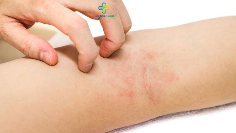 Da trở nên sần sùi, thiếu độ ẩm và dễ bị nứt nẻ