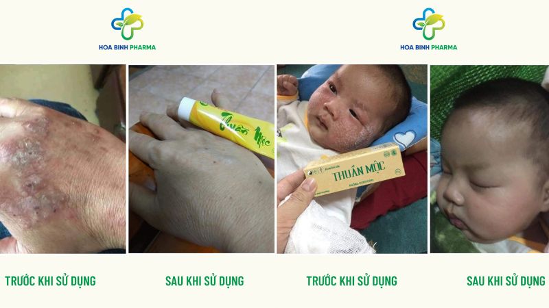 Sản phẩm đã và đang được nhiều bác sĩ da liễu tin tưởng sử dụng lâm sàng trong các phác đồ hỗ trợ điều trị viêm da