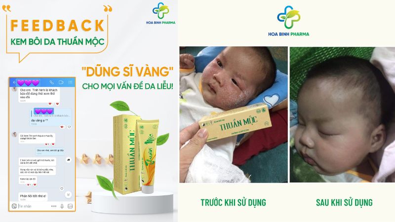 Kem Thuần Mộc không chứa corticoid, an toàn cho cả trẻ nhỏ và người có làn da nhạy cảm