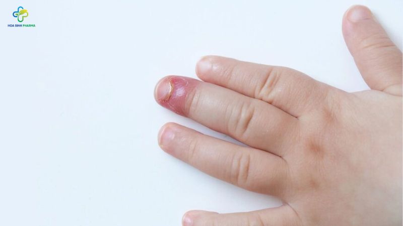 Cả nấm da và nấm móng đều có thể lây lan nhanh qua tiếp xúc trực tiếp hoặc qua vật dụng cá nhân