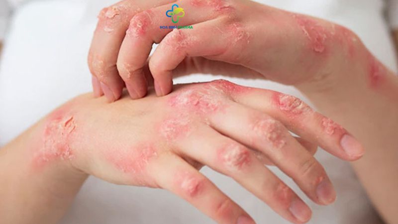 Viêm da cơ địa (hay còn gọi là chàm thể tạng) là một bệnh viêm da mạn tính phổ biến