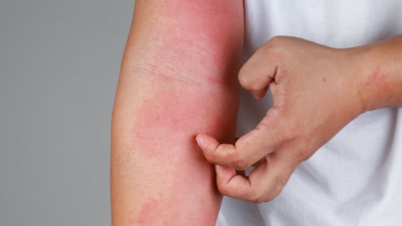 Cách trị ngứa da bằng thiên nhiên luôn là lựa chọn ưu tiên của nhiều người bởi tính an toàn, lành tính và hiệu quả bền vững